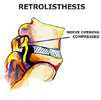 retrolisthesis.jpg retrolisthesis.jpg